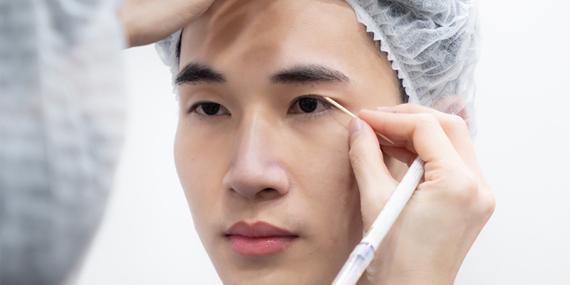 Upper & Lower Male Eyelid Surgery in Ho Chi Minh: Cost, Forms, Methods, Recovery Time and Important Notes 1 Upper & Lower Male Eyelid Surgery in Vietnam