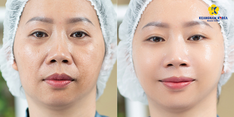 Results after performing endoscopic facelift 1