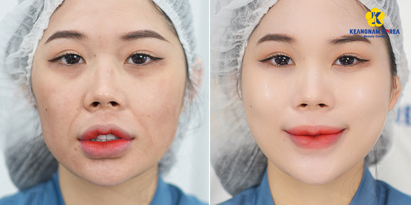 Results after performing Endoscopic Facelift 2