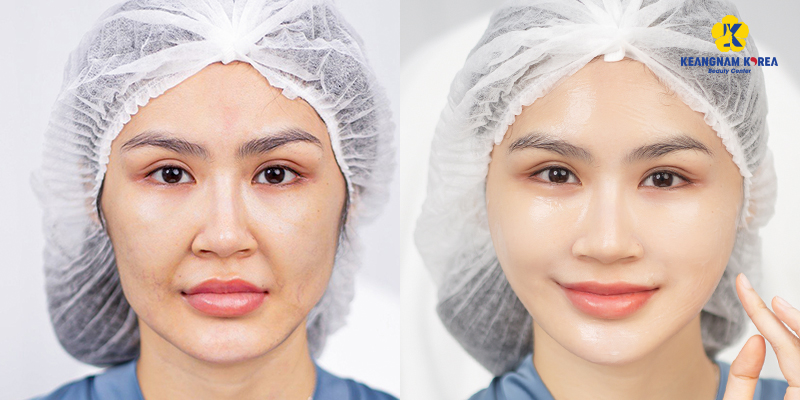 Results after performing Endoscopic Facelift 3