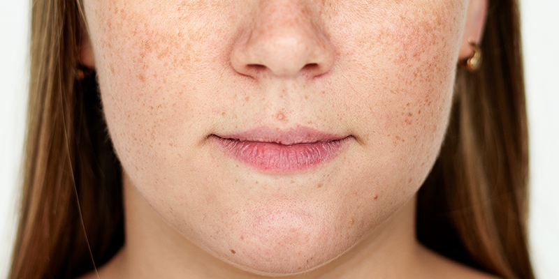 The most effective ways to treat long-term melasma and freckles