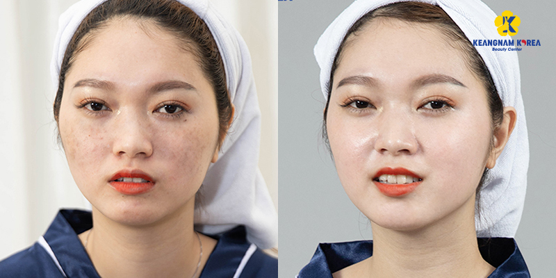 How to treat long-term melasma and freckles in keangnam Korea
