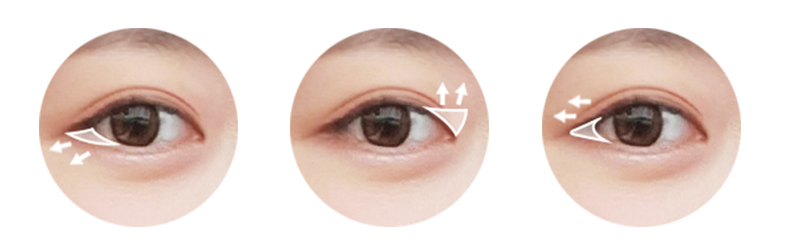 4 Eye Widening Surgery Options in Vietnam: Cost, Recovery Time, Candidates 2 eye widening surgery cost