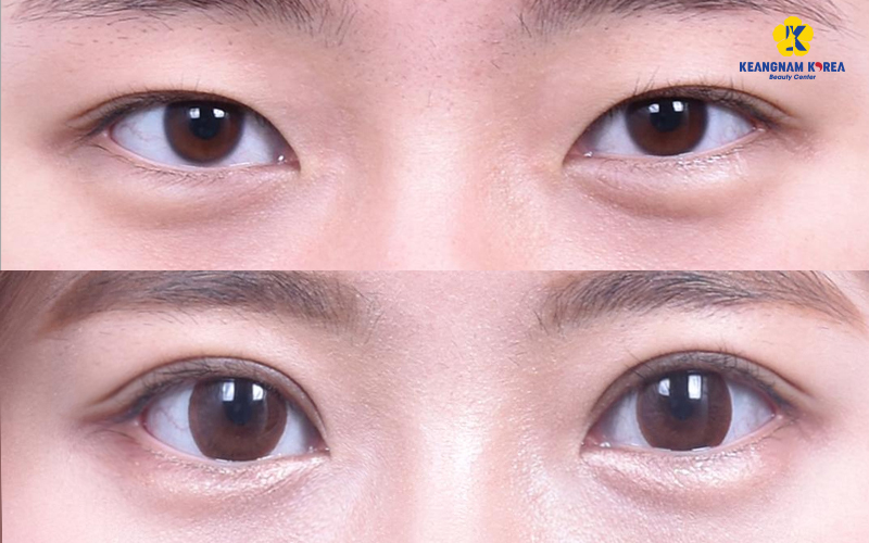 4 Eye Widening Surgery Options in Vietnam: Cost, Recovery Time, Candidates 3 eye widening surgery cost