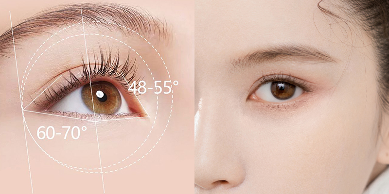 4 Eye Widening Surgery Options in Vietnam: Cost, Recovery Time, Candidates 1 eye widening surgery cost