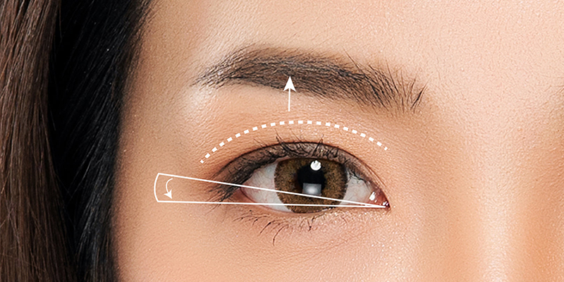 When Should You Consider Eyelid Tightening? Complete 2026 Surgery Cost Guide 1 What Is Eyelid Tightening