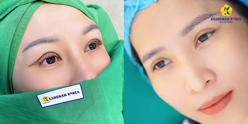 When Should You Consider Eyelid Tightening? Complete 2026 Surgery Cost Guide 4 Where to Get Eyelid Tightening Surgery Done Safely