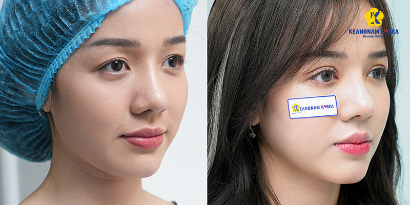 When Should You Consider Eyelid Tightening? Complete 2026 Surgery Cost Guide 3 Eyelid Tightening Procedure