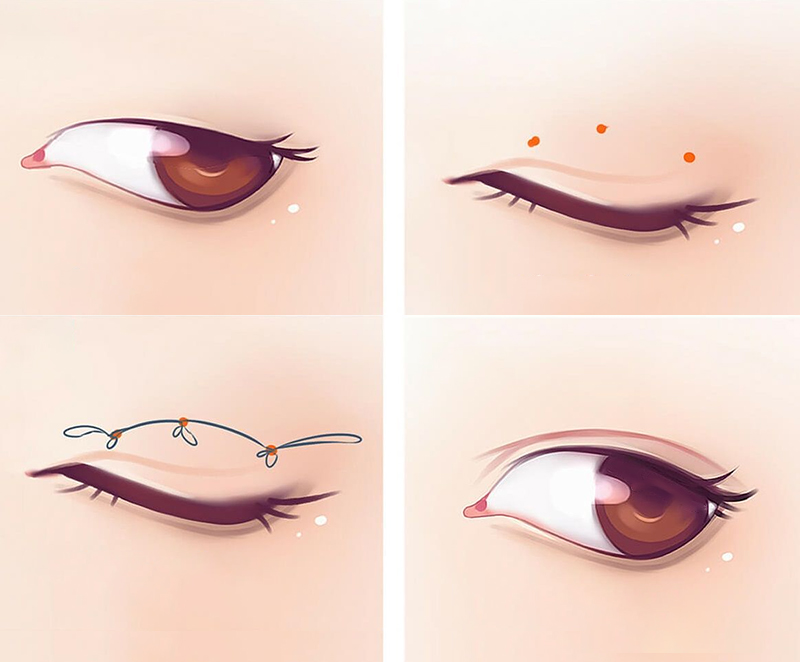 Incisional vs. Non-Incisional Double Eyelid: Which Lasts Longer? 2 Incisional vs. Non-Incisional Double Eyelid