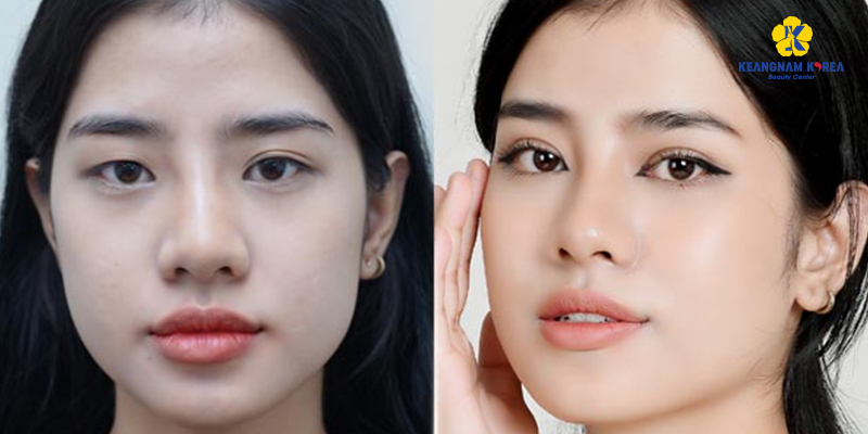 Incisional vs. Non-Incisional Double Eyelid: Which Lasts Longer? 3 Incisional vs. Non-Incisional Double Eyelid