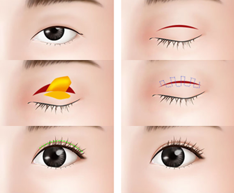 Incisional vs. Non-Incisional Double Eyelid: Which Lasts Longer? 4 Incisional vs. Non-Incisional Double Eyelid