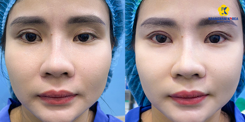 Incisional vs. Non-Incisional Double Eyelid: Which Lasts Longer? 5 Incisional vs. Non-Incisional Double Eyelid