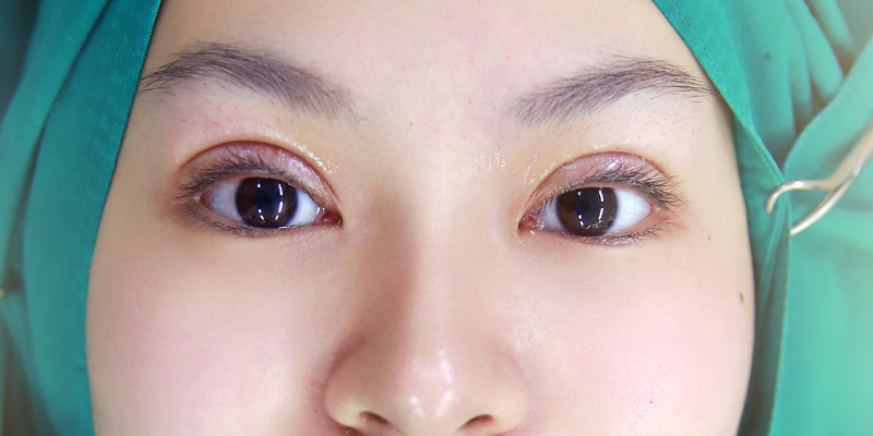 Incisional vs. Non-Incisional Double Eyelid: Which Lasts Longer? 6 Incisional vs. Non-Incisional Double Eyelid