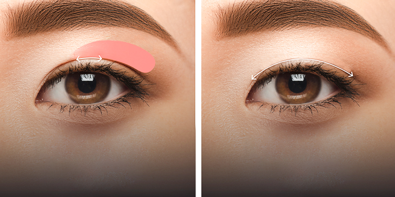 Incisional vs. Non-Incisional Double Eyelid: Which Lasts Longer? 1 Incisional vs. Non-Incisional Double Eyelid