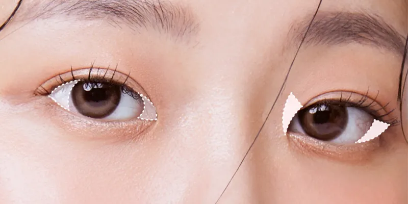 What Is Inner and Outer Corner Eye Surgery? Techniques, Costs, and Recovery 1 inner and outer corner eye surgery