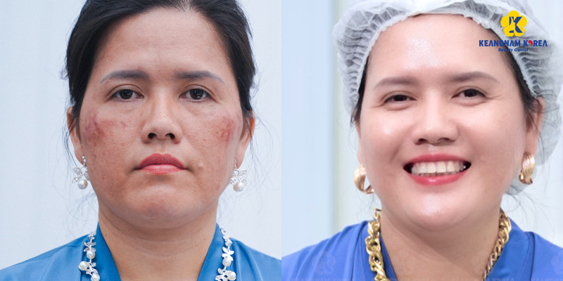 Results of facial melasma treatment in Keangnam Korea