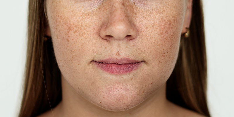 What are melasma spots? Causes and treatments for perennial facial melasma