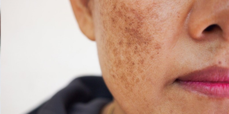What is mixed melasma? Causes and effective ways to treat melasma and freckles