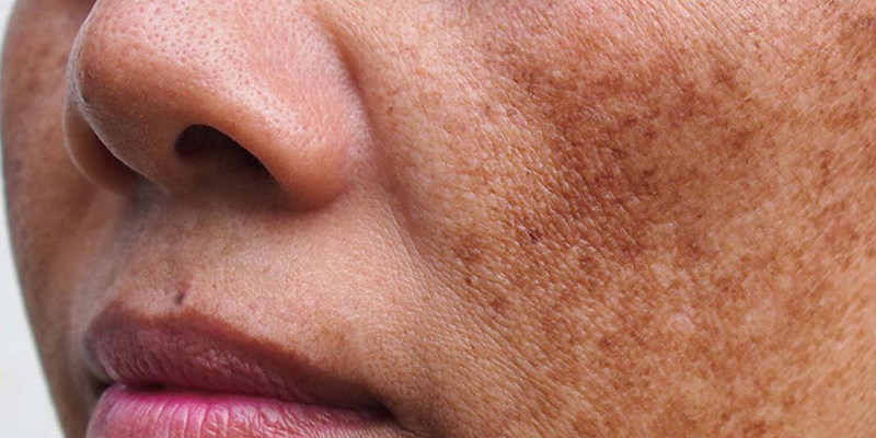 What is melasma? Causes and effective treatments for facial melasma