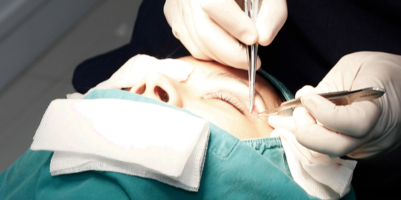 Eye Lift for Hooded Eyes in Vietnam: Surgery Types, Cost, and Recovery 1 Eye Lift for Hooded Eyes in Vietnam