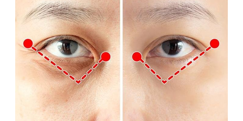 Eye Lift for Hooded Eyes in Vietnam: Surgery Types, Cost, and Recovery 2 Eye Lift for Hooded Eyes in Vietnam