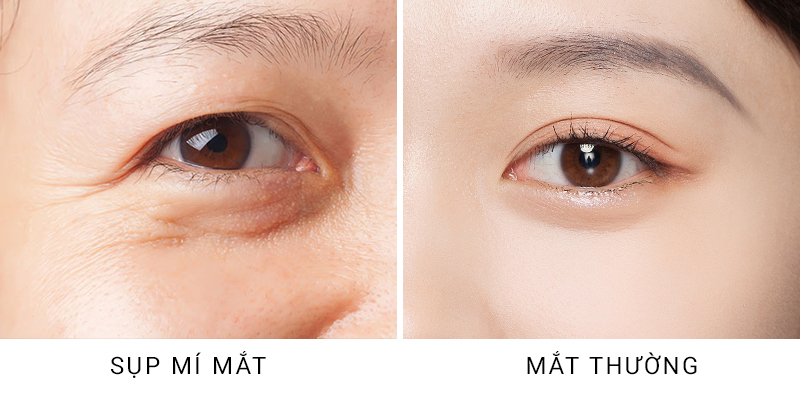 Ptosis Correction Surgery or the Suture Method: Which Is Better for Your Eyelid Shape? 2 ptosis correction surgery