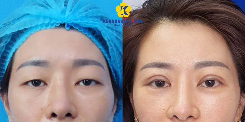 Ptosis Correction Surgery or the Suture Method: Which Is Better for Your Eyelid Shape? 3 Treatment for One Droopy Eyelid