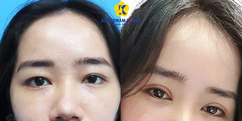 Ptosis Correction Surgery or the Suture Method: Which Is Better for Your Eyelid Shape? 4 Pros & Cons of Suture Method