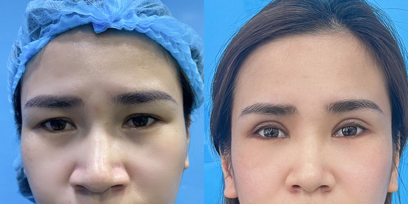 Ptosis Correction Surgery or the Suture Method: Which Is Better for Your Eyelid Shape? 5 droopy eyelid surgery