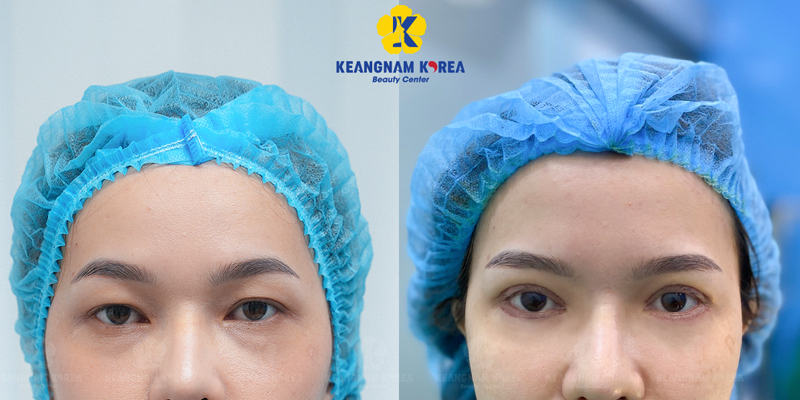 Ptosis Correction Surgery or the Suture Method: Which Is Better for Your Eyelid Shape? 6 ptosis correction surgery