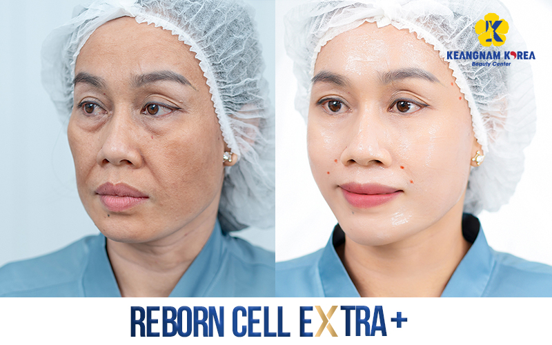 How Much Does Facelift Cost In Vietnam? 2026 Price List And Guide 2 Facelift Cost In Vietnam 2026