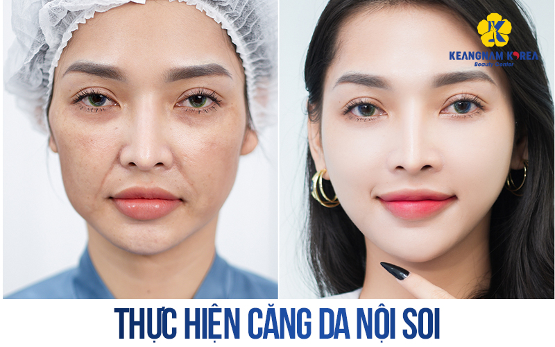 How Much Does Facelift Cost In Vietnam? 2026 Price List And Guide 4 Facelift Cost In Vietnam 2026