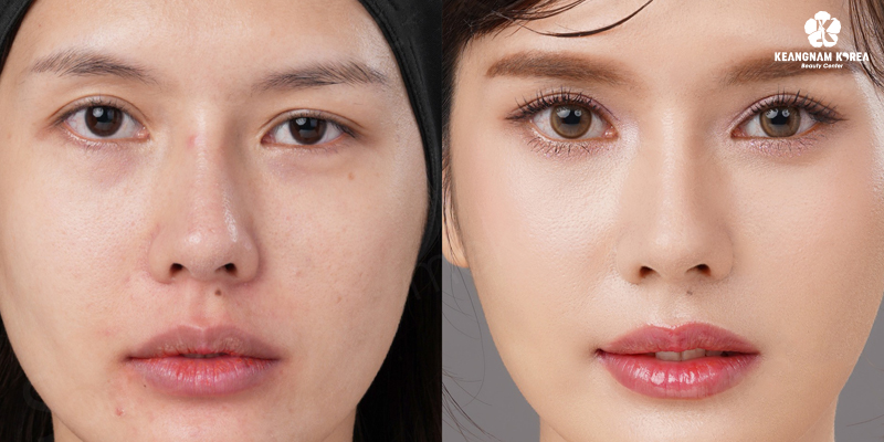 Brow Lift or Upper Eyelid Surgery: Which Truly Rejuvenates Aging Eyes? 3 Upper Eyelid Surgery