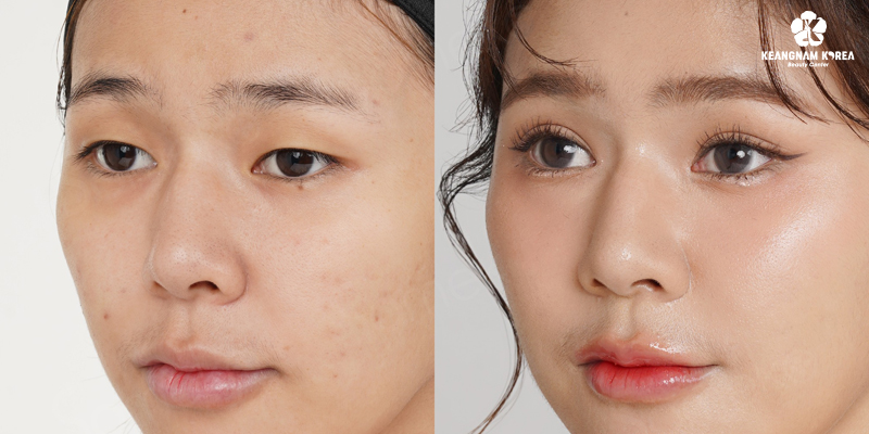 Brow Lift or Upper Eyelid Surgery: Which Truly Rejuvenates Aging Eyes? 2 Eyebrow Lift Surgery