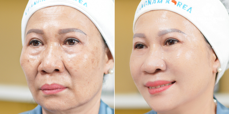 What Is An Endoscopic Facelift? How Long Does It Last 2 Is an Endoscopic Facelift Worth It?