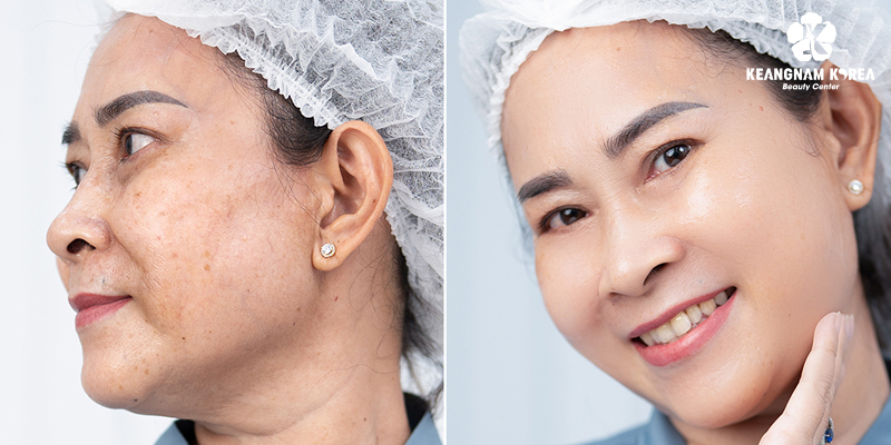 What Is An Endoscopic Facelift? How Long Does It Last 1 What Is an Endoscopic Facelift?