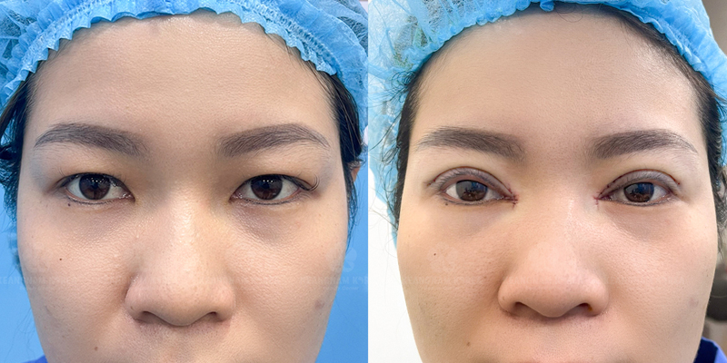 Eyelid Lift Cost 2026: Blepharoplasty Prices, Brow Lift, and What to Expect 4 Eyelid Lift Cost 2026