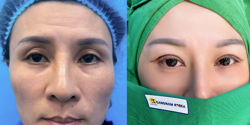 Eyelid Lift Cost 2026: Blepharoplasty Prices, Brow Lift, and What to Expect 1 Eyelid Lift Cost 2026
