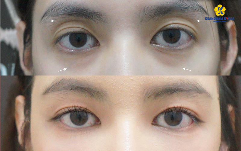 Under-Eye Fat Repositioning in Ho Chi Minh: Are You a Candidate? 2026 Guide 3 Autologous Fat Transfer Under the Eye