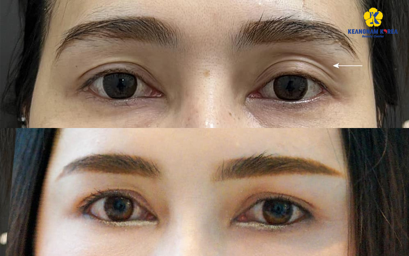 Under-Eye Fat Repositioning in Ho Chi Minh: Are You a Candidate? 2026 Guide 4 Upper Eyelid Fat Grafting
