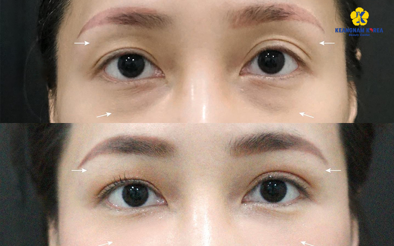Under-Eye Fat Repositioning in Ho Chi Minh: Are You a Candidate? 2026 Guide 5 Lower Eyelid Fat Grafting
