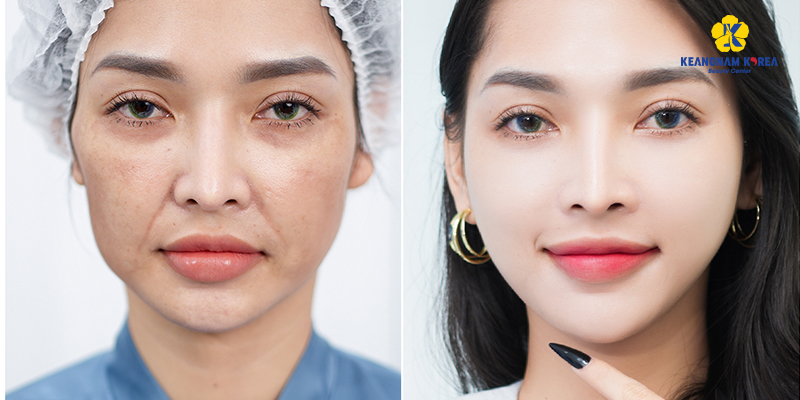 The 7 Best Glass Skin Treatment in Vietnam: Benefits, Results, Cost, Comparison 4 glass skin treatment