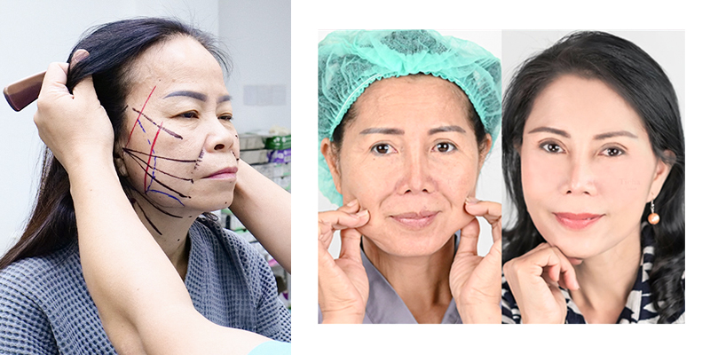Phẫu thuật căng da mặt là gì?