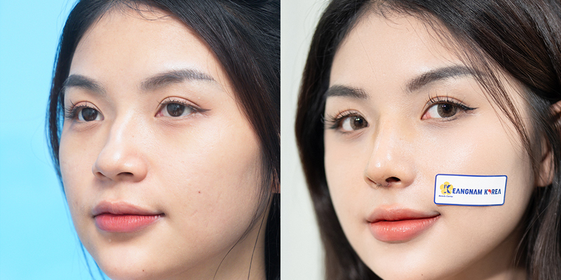 Rhinoplasty or Eyelid Surgery First? 2 rhinoplasty or eyelid surgery first