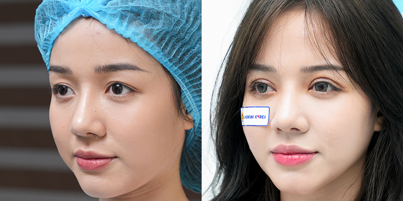 Rhinoplasty or Eyelid Surgery First? 3 rhinoplasty or eyelid surgery first