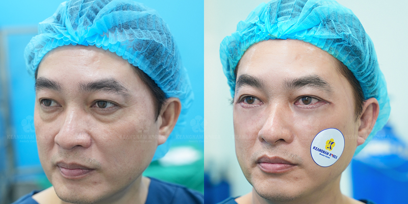 Rhinoplasty or Eyelid Surgery First? 4 rhinoplasty or eyelid surgery first