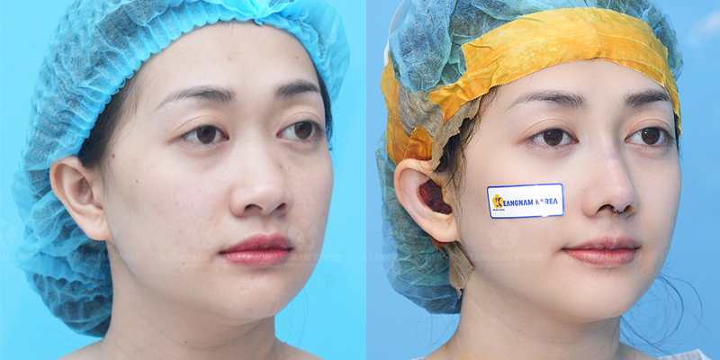 Rhinoplasty or Eyelid Surgery First? 5 rhinoplasty or eyelid surgery first