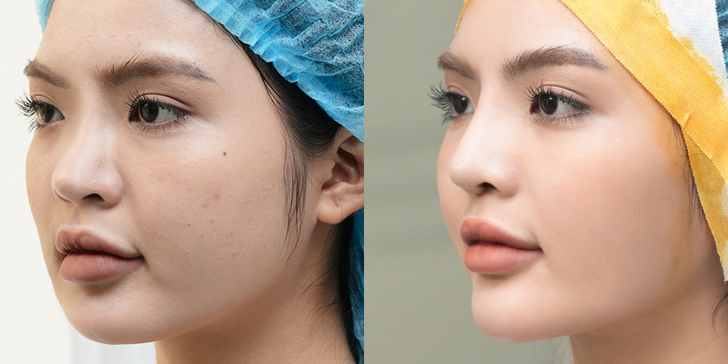 Rhinoplasty or Eyelid Surgery First? 6 rhinoplasty or eyelid surgery first