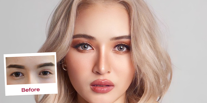 Rhinoplasty or Eyelid Surgery First? 7 rhinoplasty or eyelid surgery first