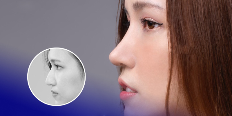 Rhinoplasty or Eyelid Surgery First? 1 rhinoplasty or eyelid surgery first